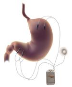 MetaCure cura il diabete senza medicine